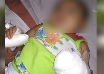 કમ્પાઉન્ડરે સોય કાઢવાના બદલે બાળકીનો અંગુઠો જ કાઢી લીધો..