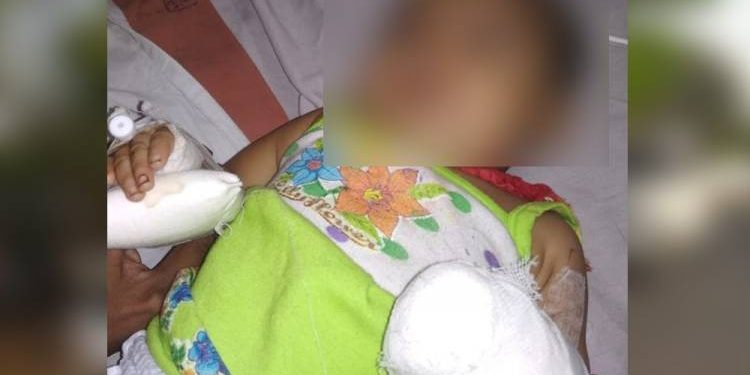 કમ્પાઉન્ડરે સોય કાઢવાના બદલે બાળકીનો અંગુઠો જ કાઢી લીધો..