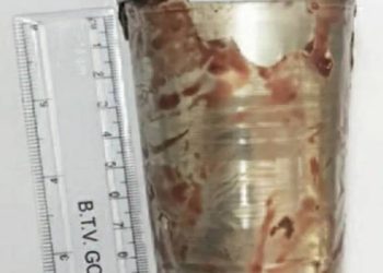 દુખાવો થતા યુવક હોસ્પિટલ પહોંચ્યો, અને પેટમાંથી નીકળ્યો…