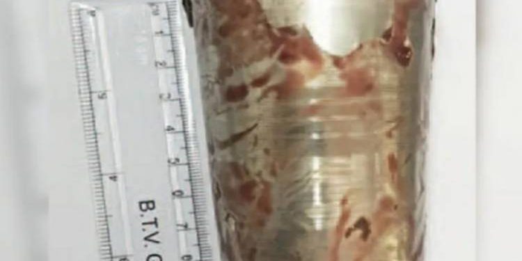 દુખાવો થતા યુવક હોસ્પિટલ પહોંચ્યો, અને પેટમાંથી નીકળ્યો…