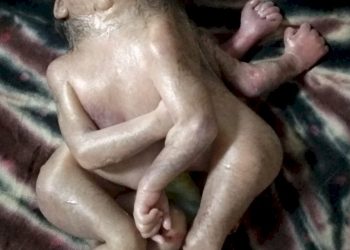 ખંભાળિયાની સરકારી હોસ્પીટલમાં પ્રસુતાએ 4 હાથ અને 4 પગવાળા બાળકને આપ્યો જન્મ..