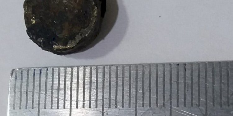 5 માસથી 6 વર્ષના બાળકના નાકમાં ફસાયેલ બેટરીસેલ તબીબે સફળતાપુર્વક કાઢ્યો 