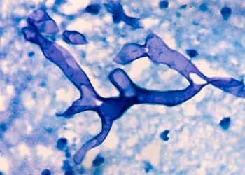 મ્યુકરમાયકોસીસ રોગચાળાના ટ્રિટમેન્ટ પ્રોટોકોલ-સારવારમાં એક સુત્રતા માટે 11 તજજ્ઞ-તબીબોની ટાસ્કફોર્સની રચના કરાઈ