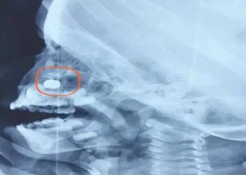 3 વર્ષના બાળકના નાકમાં રાખડીમાં રહેલ LED લાઈટનો સેલ ફસાઈ ગયો, ડોકટરે કરવી પડી સર્જરી