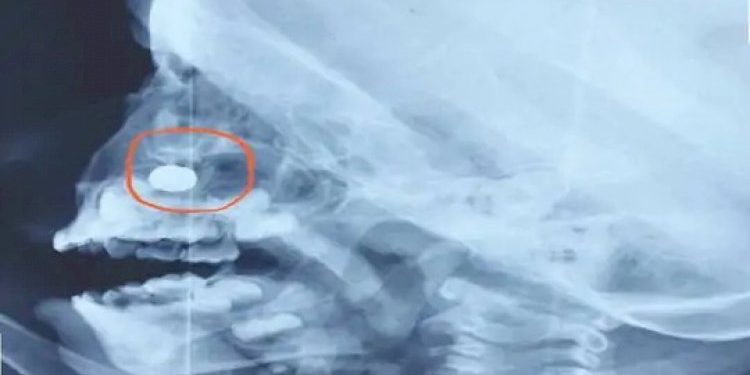 3 વર્ષના બાળકના નાકમાં રાખડીમાં રહેલ LED લાઈટનો સેલ ફસાઈ ગયો, ડોકટરે કરવી પડી સર્જરી