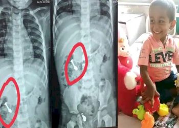 આ બાળકના આંતરડામાં એ રીતે ફસાયો સ્ક્રુ કે તબીબોને પણ ઉઠાવવી પડી ભારે જહેમત