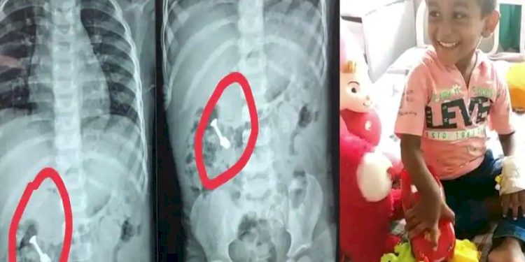 આ બાળકના આંતરડામાં એ રીતે ફસાયો સ્ક્રુ કે તબીબોને પણ ઉઠાવવી પડી ભારે જહેમત