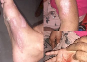 પૂરી અને લાડવા ખાધા તો સાવકી માં એ ફૂલ જેવી દીકરીના શરીર પર ડામ દીધા, શું પોલીસ ભરશે પગલા.?