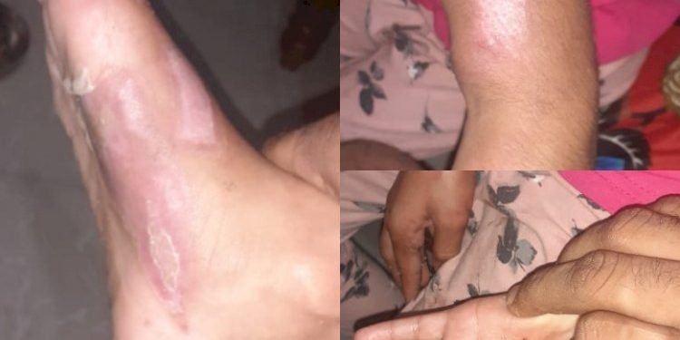 પૂરી અને લાડવા ખાધા તો સાવકી માં એ ફૂલ જેવી દીકરીના શરીર પર ડામ દીધા, શું પોલીસ ભરશે પગલા.?