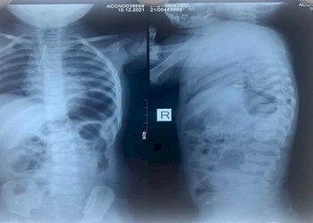 2 વર્ષની બાળકી રમકડા સાથે રમતી વખતે LED બલ્બ ગળી ગઇ