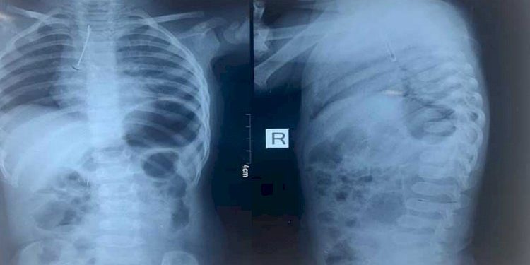 2 વર્ષની બાળકી રમકડા સાથે રમતી વખતે LED બલ્બ ગળી ગઇ