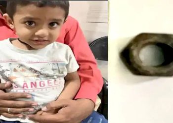 બાળકના નાકમાં ફસાઈ ગયો બોલ્ટ, સર્જરી વિના તબીબે આ રીતે બોલ્ટ બહાર કાઢ્યો 