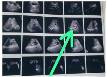 ઓપરેશન વખતે આ સગર્ભાના પેટમાં કપડું રહી જતાં…