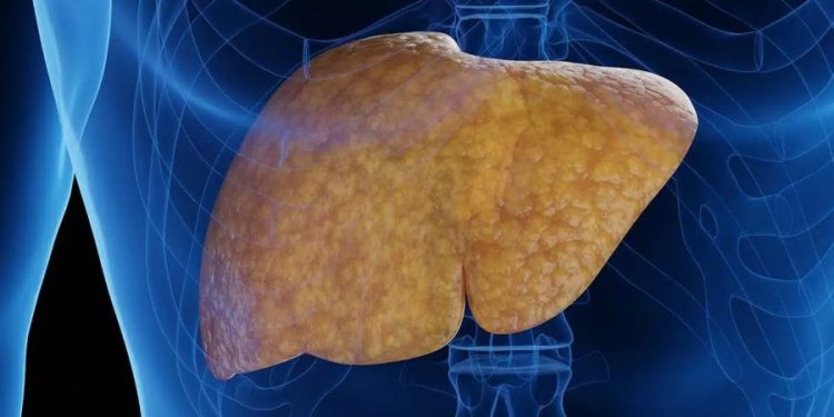 40ની ઉંમર બાદ ગુજરાતીઓના લિવર પર ‘ચરબી’ના થર ચડે છે !